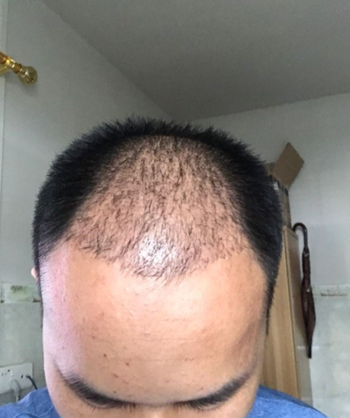 植发多久才能恢复正常(植发6个月最难熬)