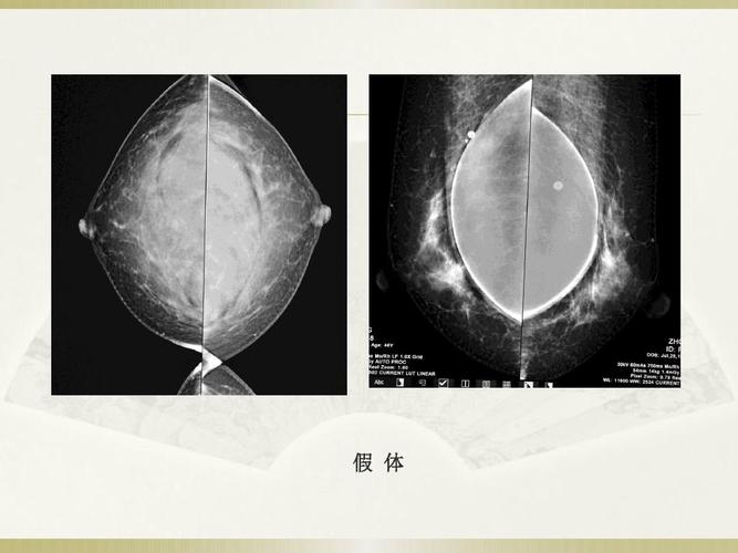 钼靶的知识百城冷知识(钼靶主要是检查什么)