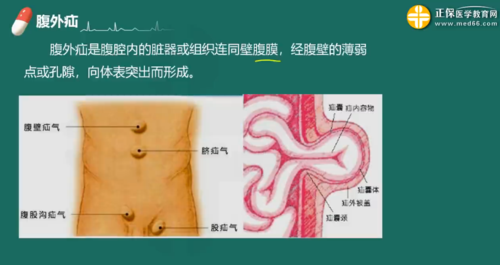 钭疝相关知识关知识点(疝的临床表现)