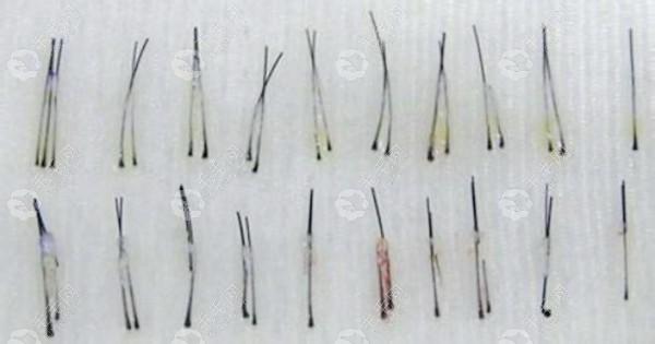 1个毛囊多少钱(一个毛囊大约多少钱)