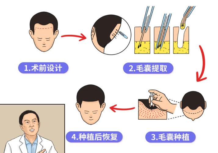 人造毛囊植发(人造毛囊植发贵吗)