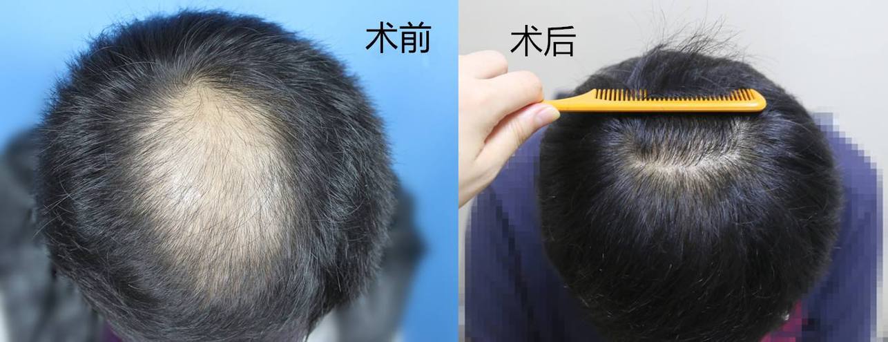 植发了解一下(植发的效果如何呀)