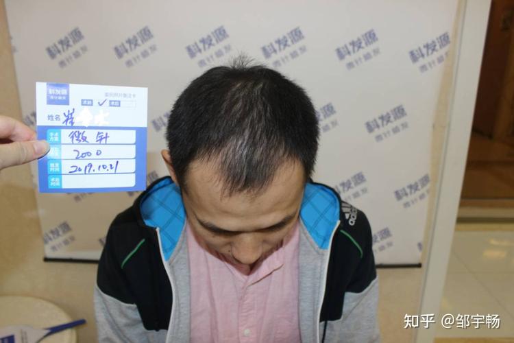 男士植发大概要多少钱(男士植发大概要多少钱一次)