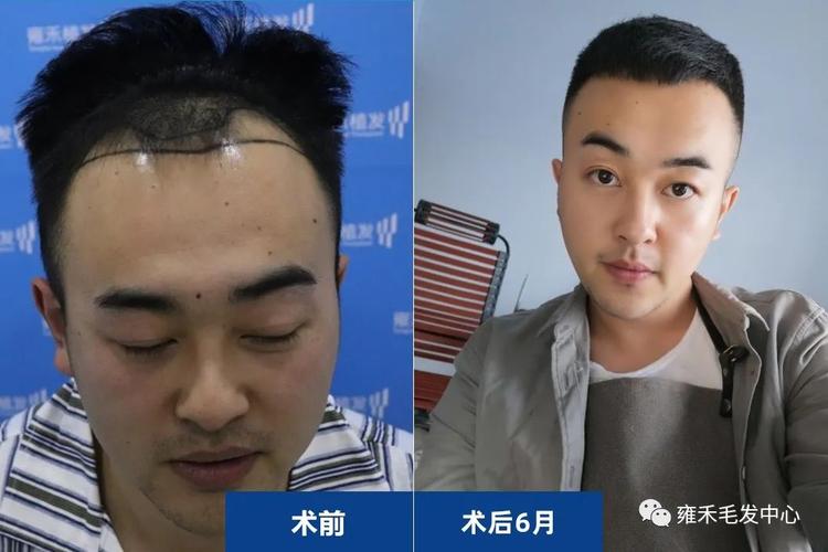 10000元植发效果图(雍禾种植毛发医院是正规的吗)